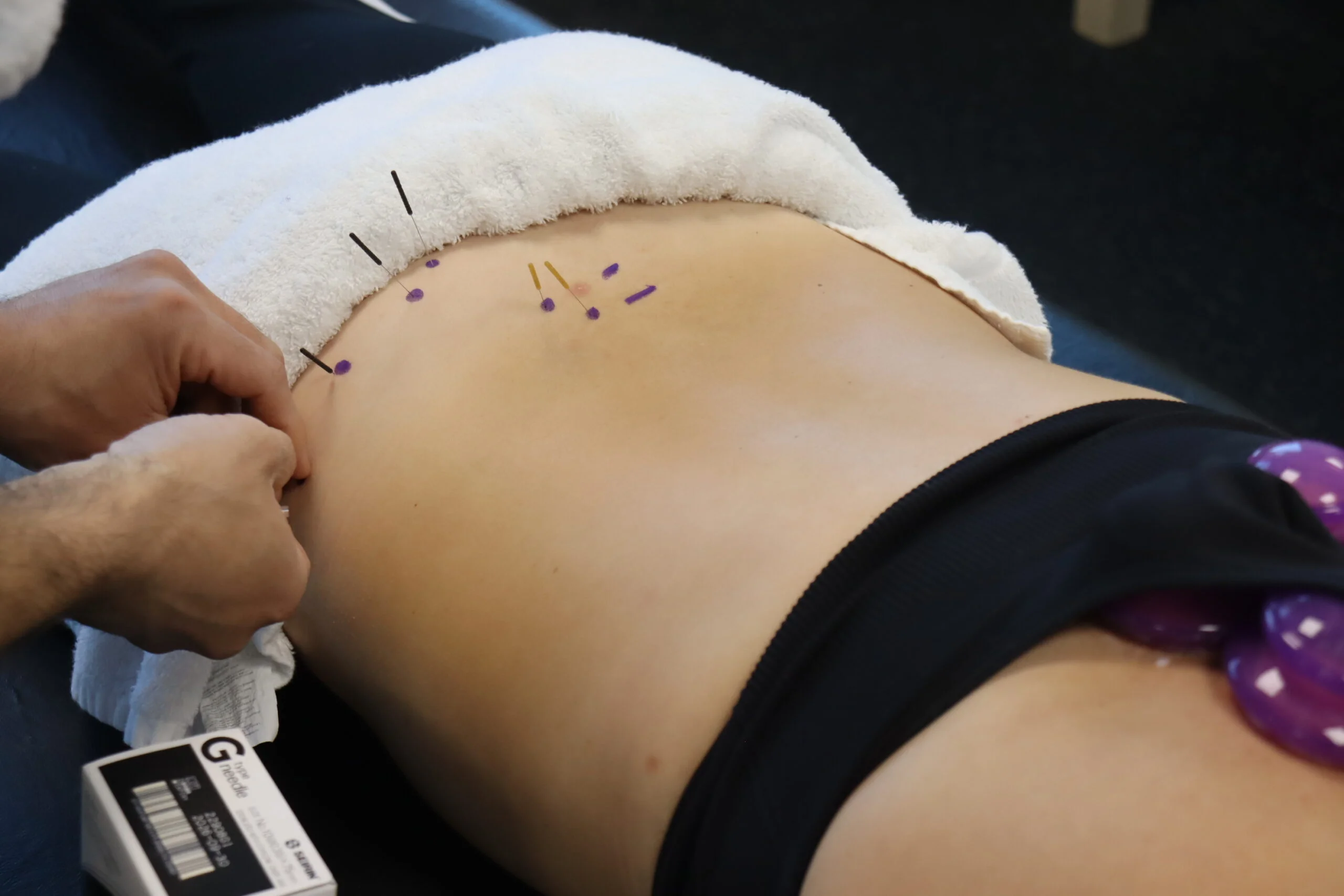 Physical Therapist performing Dry Needling