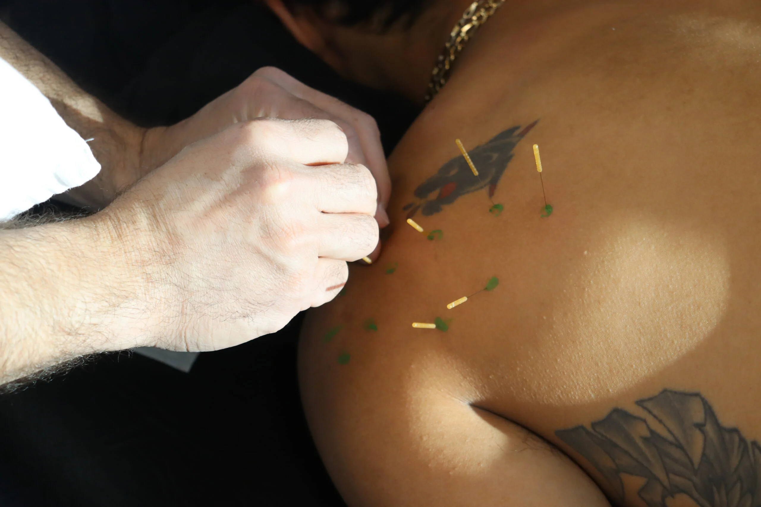 PT dry needling patient