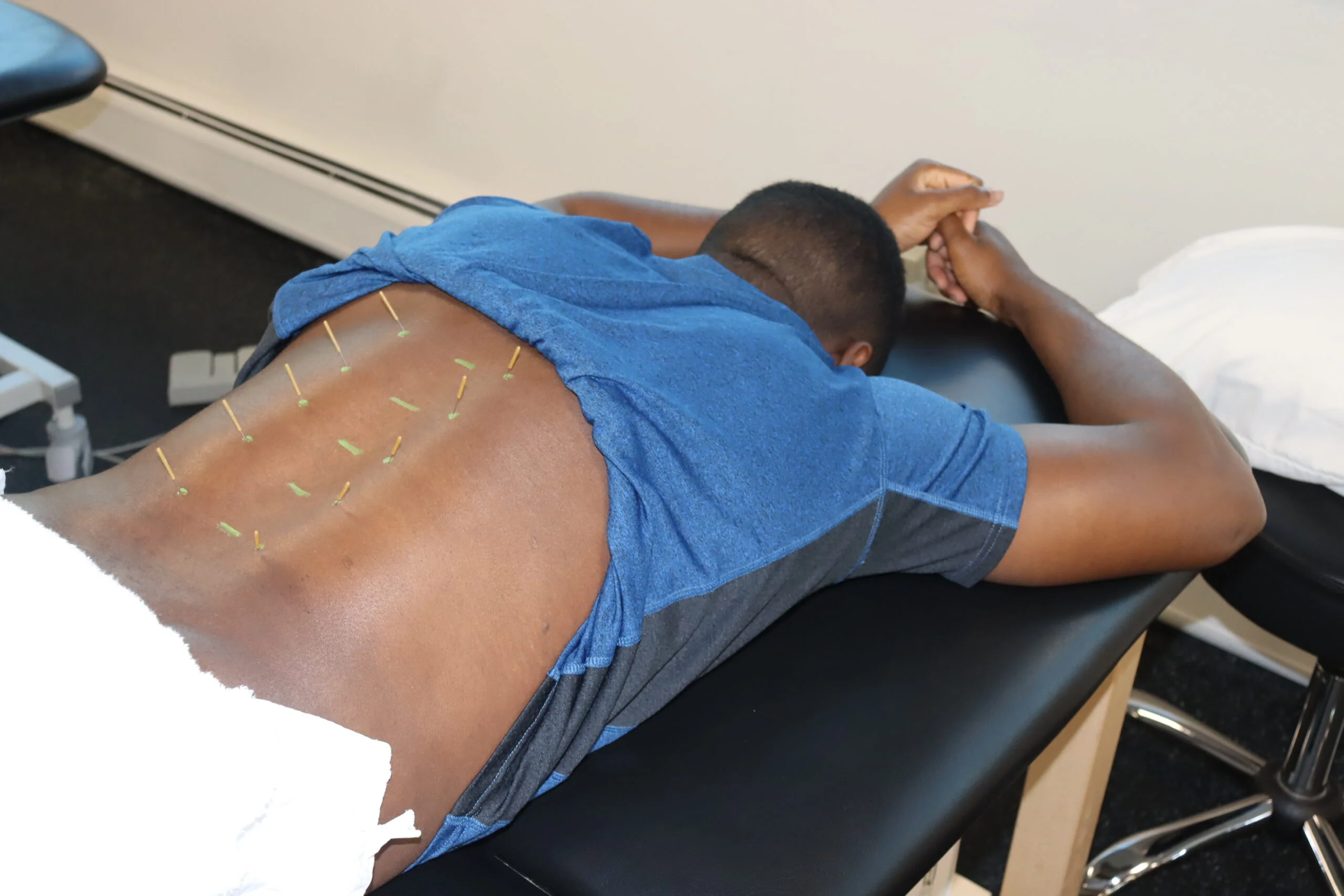 Dry Needling on back