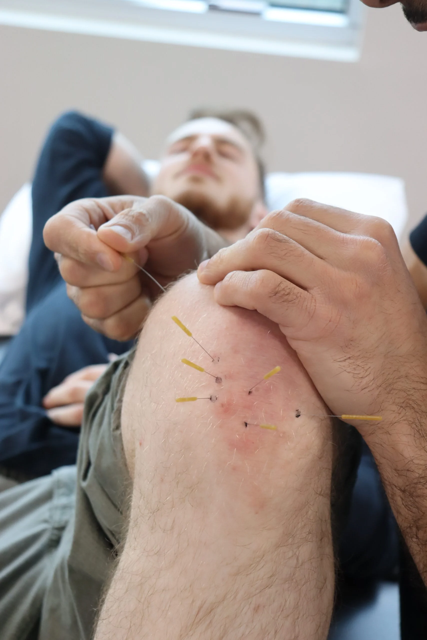 Dry Needling on Knee