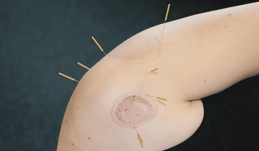 Dry Needling vs Acupuncture: Which One is Right for You?
