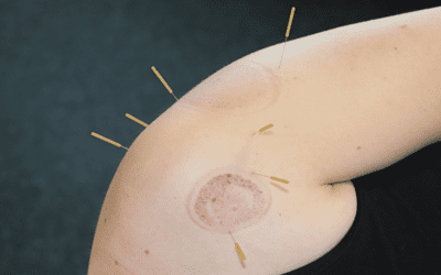 Dry Needling vs Acupuncture: Which One is Right for You?