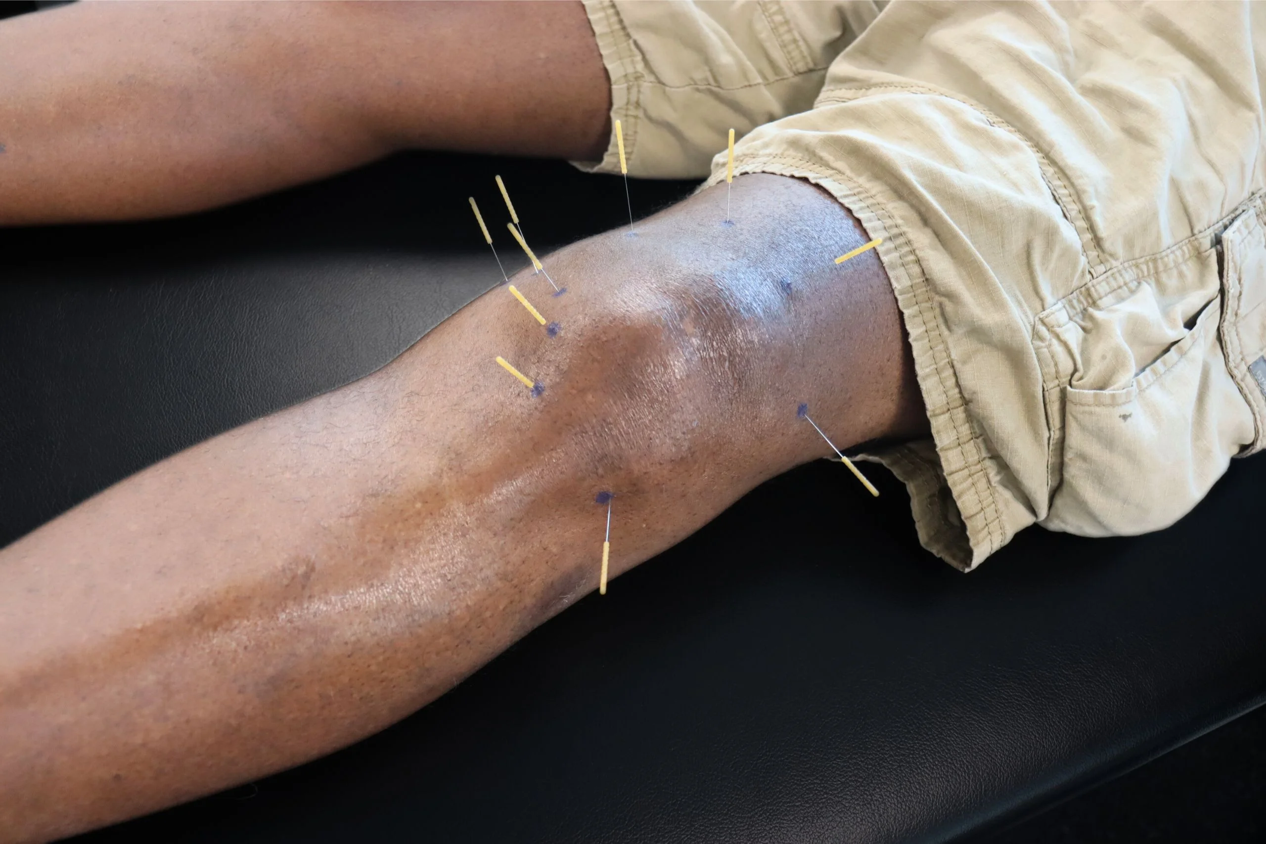 Dry Needling on Knee