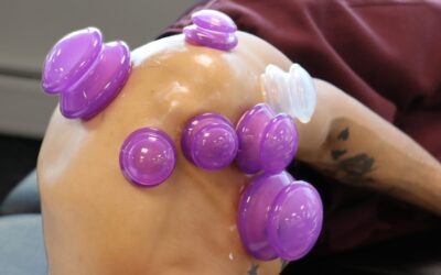 Understanding Bruising from Cupping Therapy: What it is, Causes, and Benefits