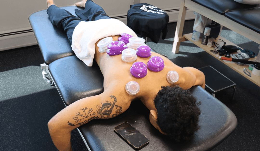 Benefits of Cupping Therapy for Stress Relief