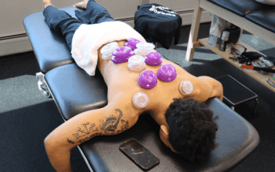 Benefits of Cupping Therapy for Stress Relief
