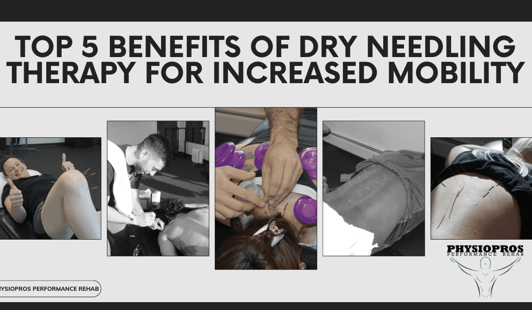 Top 5 Benefits of Dry Needling Therapy for Increased Mobility