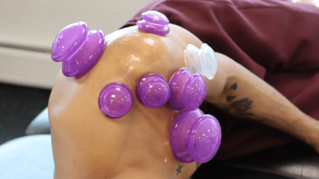 Cupping Physiopros NJ