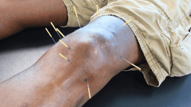 Dry Needling Physiopros NJ