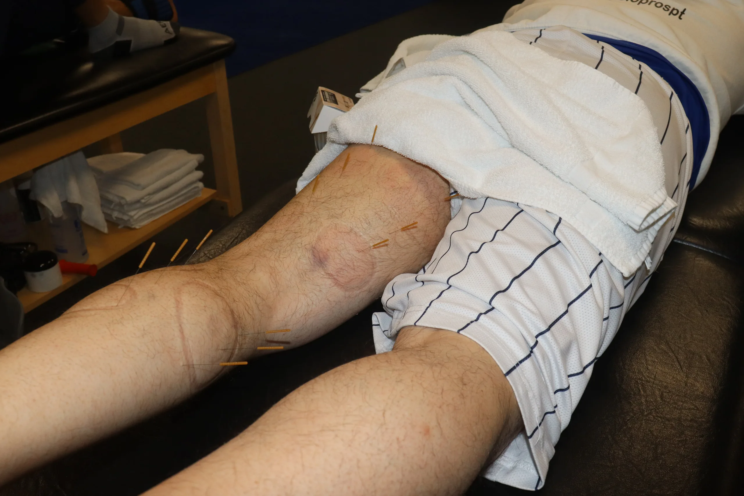 Dry Needling