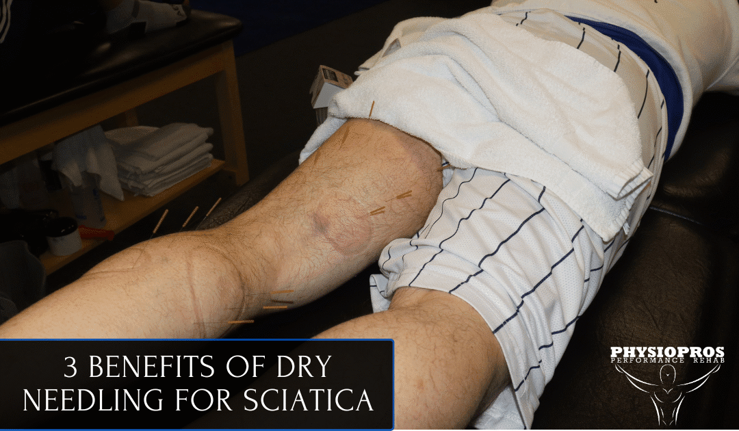 Physical Therapy Parsippany, NJ | 3 Benefits of Dry Needling for Sciatica 3 Benefits of Dry Needling for Sciatica