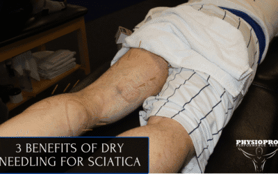 Physical Therapy Parsippany, NJ | 3 Benefits of Dry Needling for Sciatica 3 Benefits of Dry Needling for Sciatica