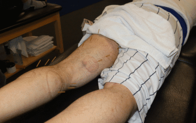 Physical Therapy Parsippany, NJ | 5 Signs It’s Time to Search ‘Dry Needling Near Me’ for Chronic Pain 5 Signs It’s Time to Search ‘Dry Needling Near Me’ for Chronic Pain