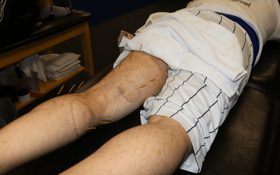 Dry Needling Physical Therapy Success Stories From Our Patients