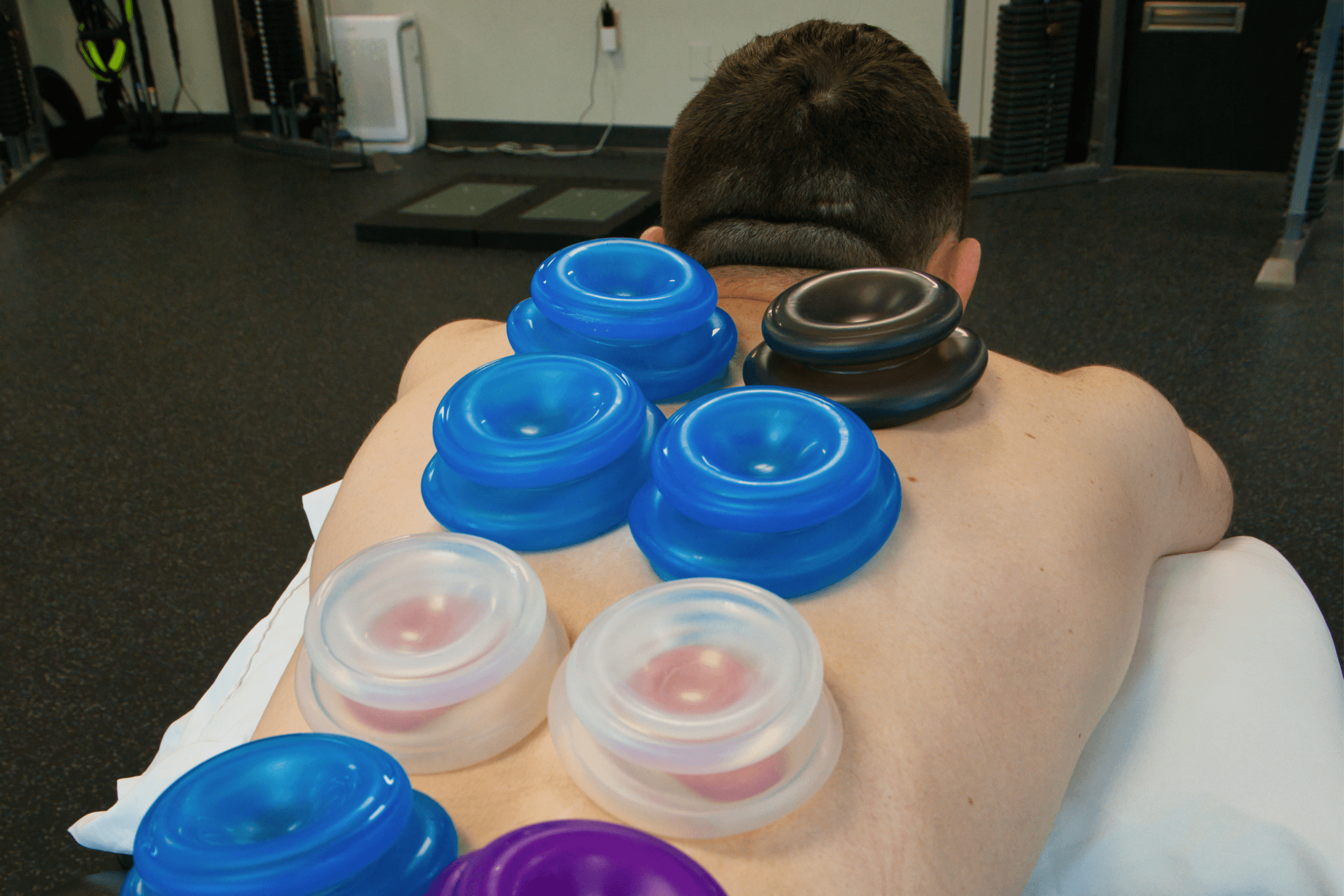Physical Therapy Parsippany, NJ | Our Gallery Cupping Therapy