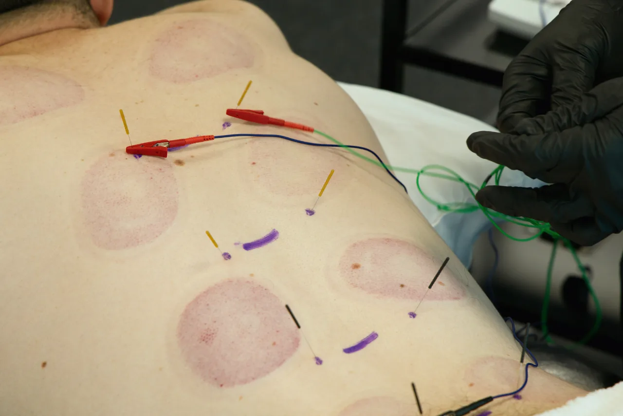 Physical Therapy Parsippany, NJ | Dry Needling Dry Needling at Physiopros PT