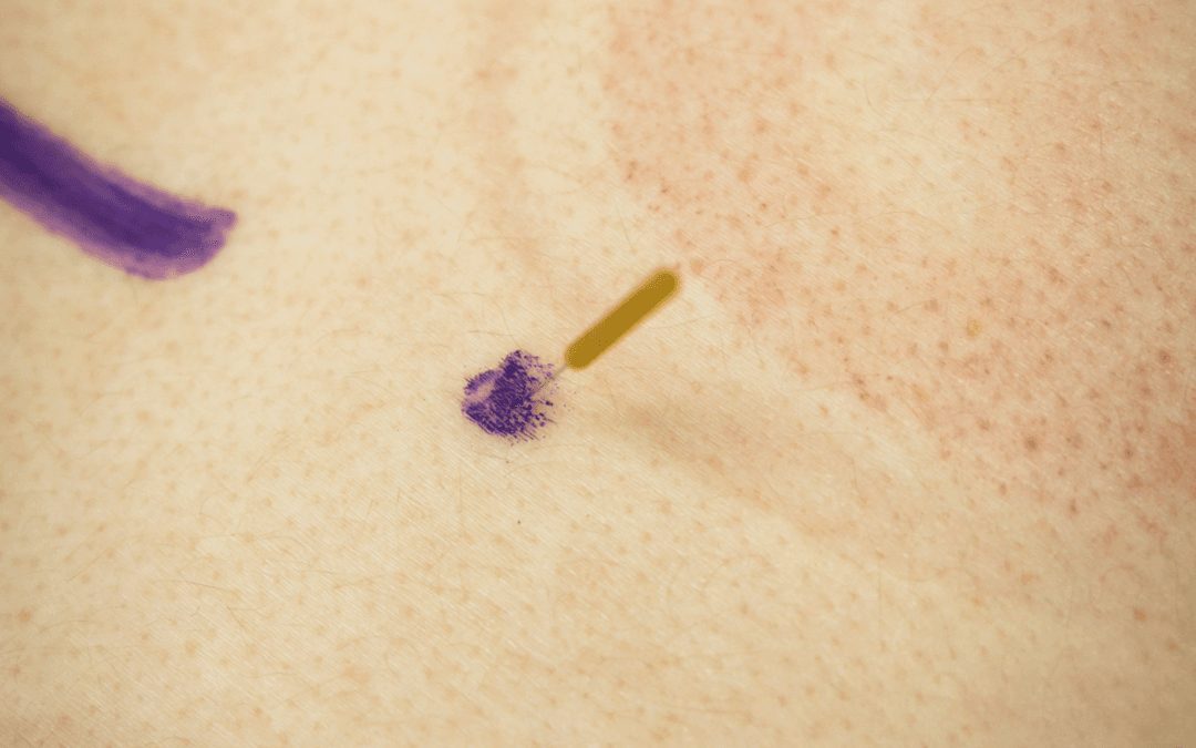 Dry Needling for Neck Pain: Is It Worth Trying?