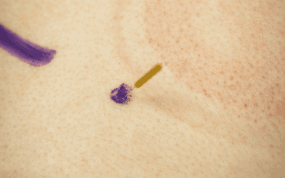Dry Needling for Neck Pain: Is It Worth Trying?