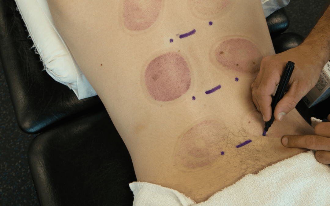 When Sciatica Physical Therapy Is the Right Next Step